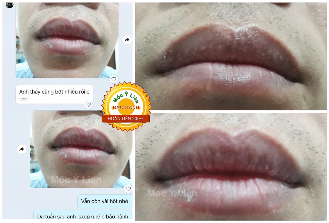 Phun Môi có Lấp Được Hạt Bã Nhờn Fordyce Môi